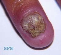 Image result for Chronic Mucocutaneous Candidiasis