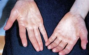 Image result for Acrocyanosis