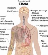 Image result for Ebola Virus Disease
