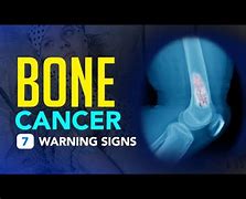 Image result for Bone Cancer