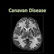 Image result for Causes Canavan Disease