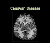 Image result for Canavan Treatment