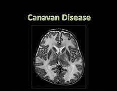 Image result for Affected Population of Canavan Disease