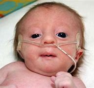 Image result for Edwards Syndrome Phenotype