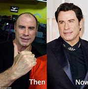 Image result for John Travolta Hair Transplant Before After