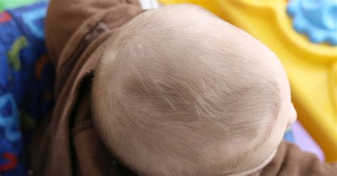 How to Treat Dry Scalp in Babies   LIVESTRONG.COM