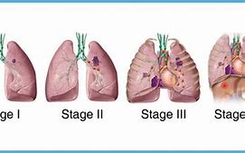 Image result for Stage 3B Lung Cancer