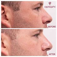 Image result for Optiphi Skin Care Results