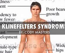 Image result for Men Who Have Klinefelter Syndrome