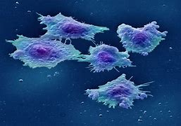 Image result for Stage 4 Colon Cancer