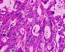 Image result for Adenocarcinoma Lung Cancer