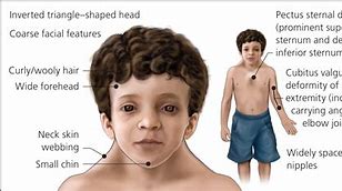 Image result for Noonan Syndrome Facies