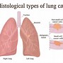 Image result for Non Small Cell Lung Cancer
