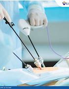 Image result for Laparoscopic Appendectomy