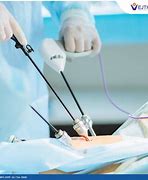 Image result for Lap Appendectomy Procedure