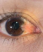 Image result for Common Eye Conditions