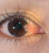 Image result for Medical Eye Conditions