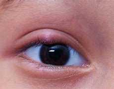 Image result for Common Eye Problems