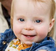 Image result for Trisomy X Syndrome