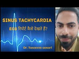 Image result for Sinus Tachycardia