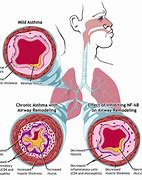 Image result for Asthma Cartoon