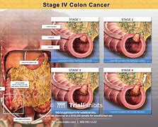 Image result for Stage 4 Bowel Cancer
