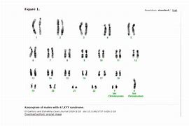 Image result for 47 XYY Karyotype