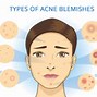 Image result for Acne Face Cream