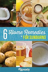Image result for Home Remedies for SunBurn