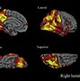 Image result for Down Syndrome Brain vs Normal Brain
