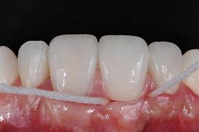Image result for Water Flossing Teeth