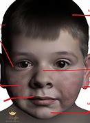 Image result for Fetal Alcohol Syndrome Face