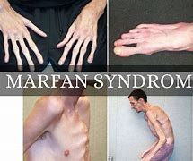 Image result for Marfan Spine