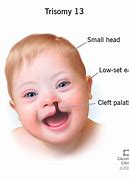 Image result for Trisomy 13 Patau Syndrome