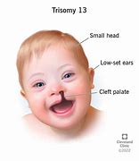 Image result for Partial Trisomy 13