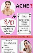 Image result for How to Cure Acne