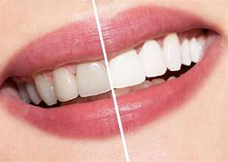 Image result for Tooth-Whitening