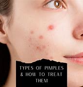 Image result for Different Types of Pimples