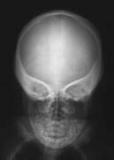 Image result for Hurler's Syndrome Bones