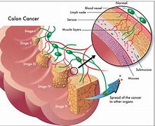 Image result for Colorectal Cancer Stages