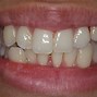 Image result for Crooked Teeth Veneers Before and After