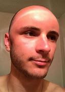 Image result for Small Dent in Head