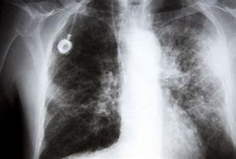 Image result for Stage 4 Lung Cancer X-ray
