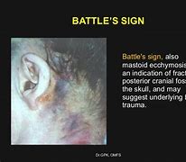 Image result for What Is Battle Sign