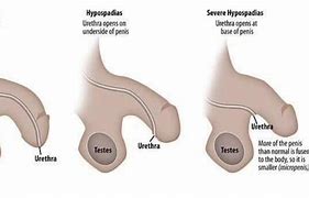 Image result for Hypospadias and Success Rates