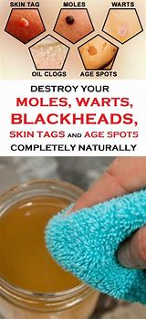 Image result for How to Remove Skin Tags Warts Moles