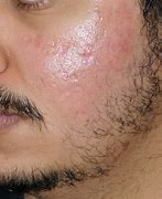Image result for Healing Scars On Face