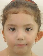 Image result for Facial Features of Goldenhar Syndrome