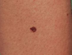 Image result for Stage 1 Melanoma Skin Cancer