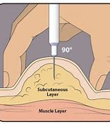 Image result for Subcutaneous Injection Sites